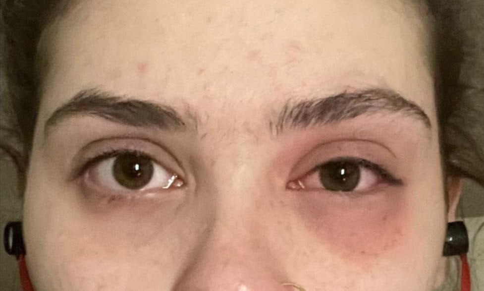Pink Eye from Bloodworms